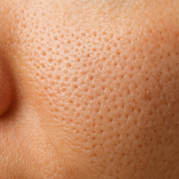 علت باز شدن منافذ پوست و راههای درمان آن علت باز شدن منافذ پوست و راههای درمان آن